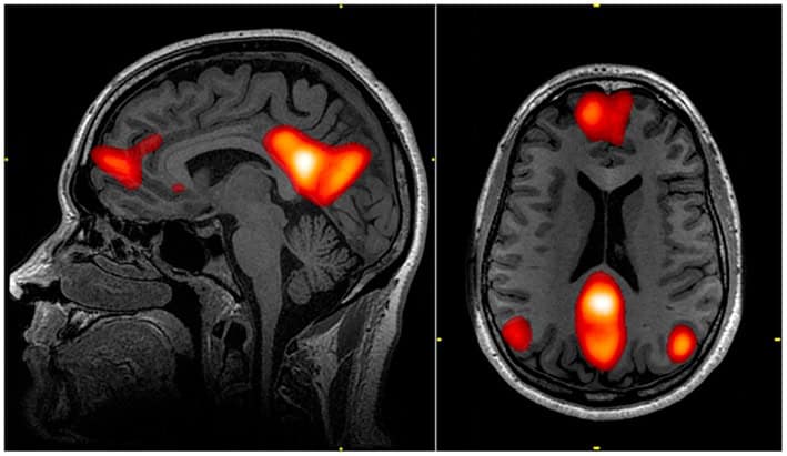 ruhezustandsnetzwerk default mode network dmn psychedelika