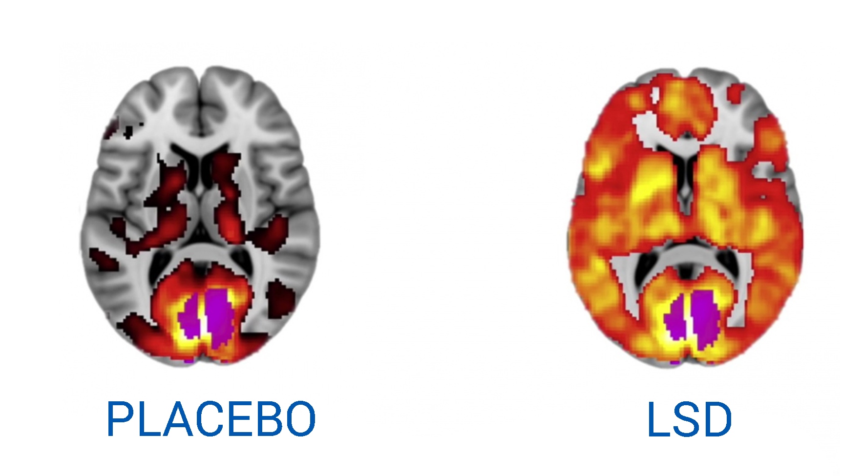 difference lsd placebo brain activity gehirn