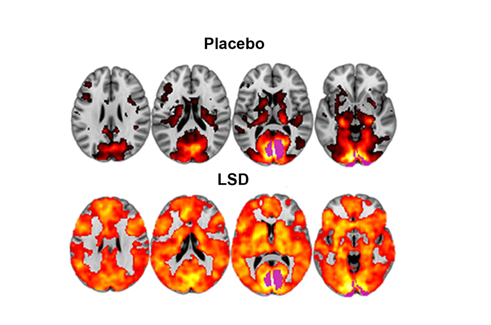 Gehirnscans zeigen Placebo- und LSD-Effekte; LSD-Scans weisen mehr orange und gelbe Aktivierungsbereiche auf.